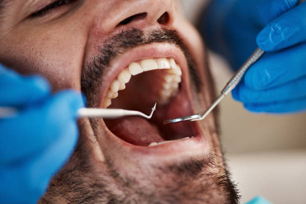 Best Emergency Treatment for Dental Infections or Abscesses in Port Angeles, WA